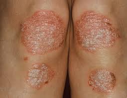 Trị bệnh vảy nến bằng đông y