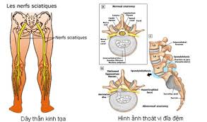 Đông y trị đau thần kinh tọa