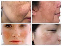 Thảo dược trị nám da