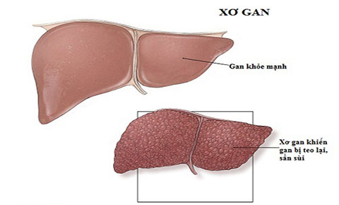 Nguyên nhân và triệu chứng của bệnh xơ gan