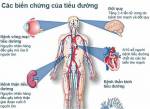 Loại bỏ những biến chứng tiểu đường bằng cách nào?