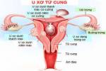 Bài thuốc trị u xơ tử cung