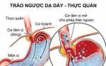 Bài thuốc trị trào ngược dạ dày thực quản